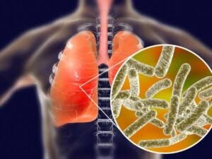 visualizzazione delle vie respiratorie umane con un ingrandimento su dei batteri di legionella, ad indicare un'infezione polmonare causata dal batterio